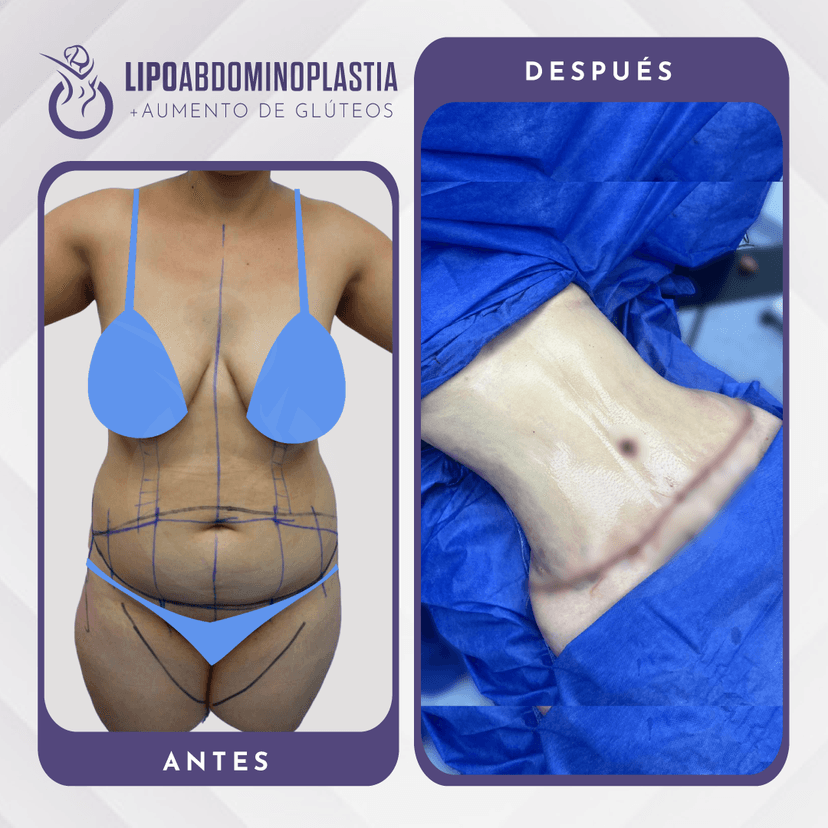 Abdominoplastia: Un Procedimiento para un Abdomen Plano y Firme