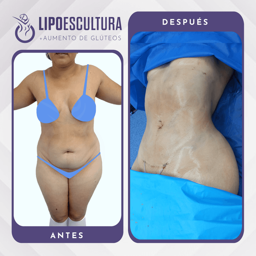 Lipoescultura con Tecnología: Opciones y Beneficios
