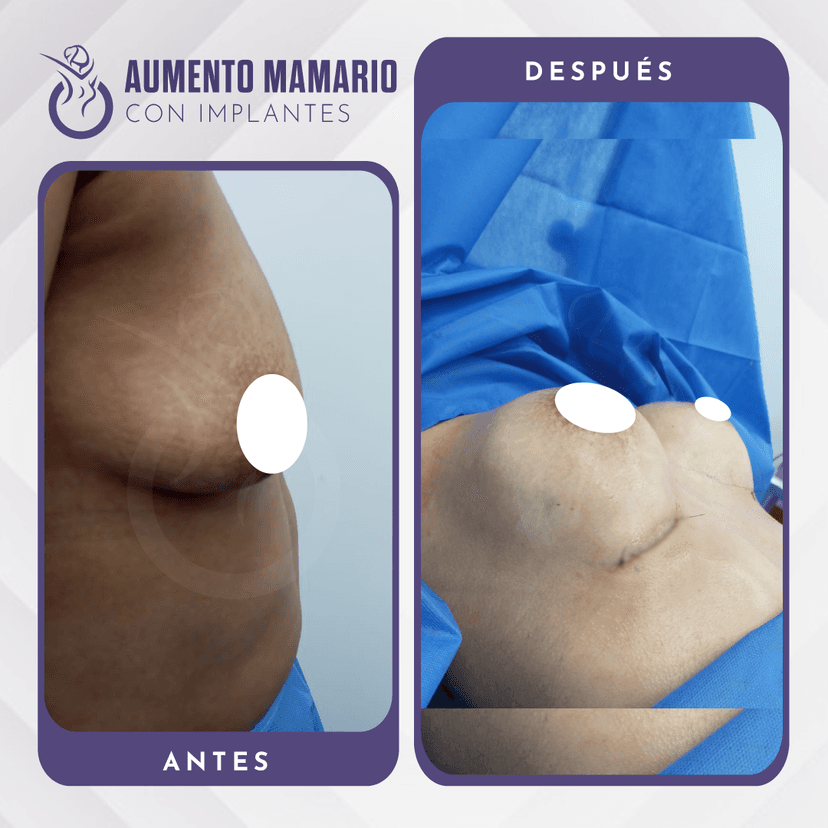 Cirugías de Mamas: Un Enfoque para una Silueta Femenina Perfecta