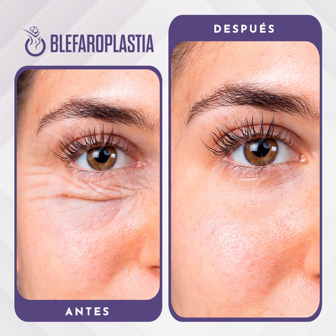 Blefaroplastia - Antes