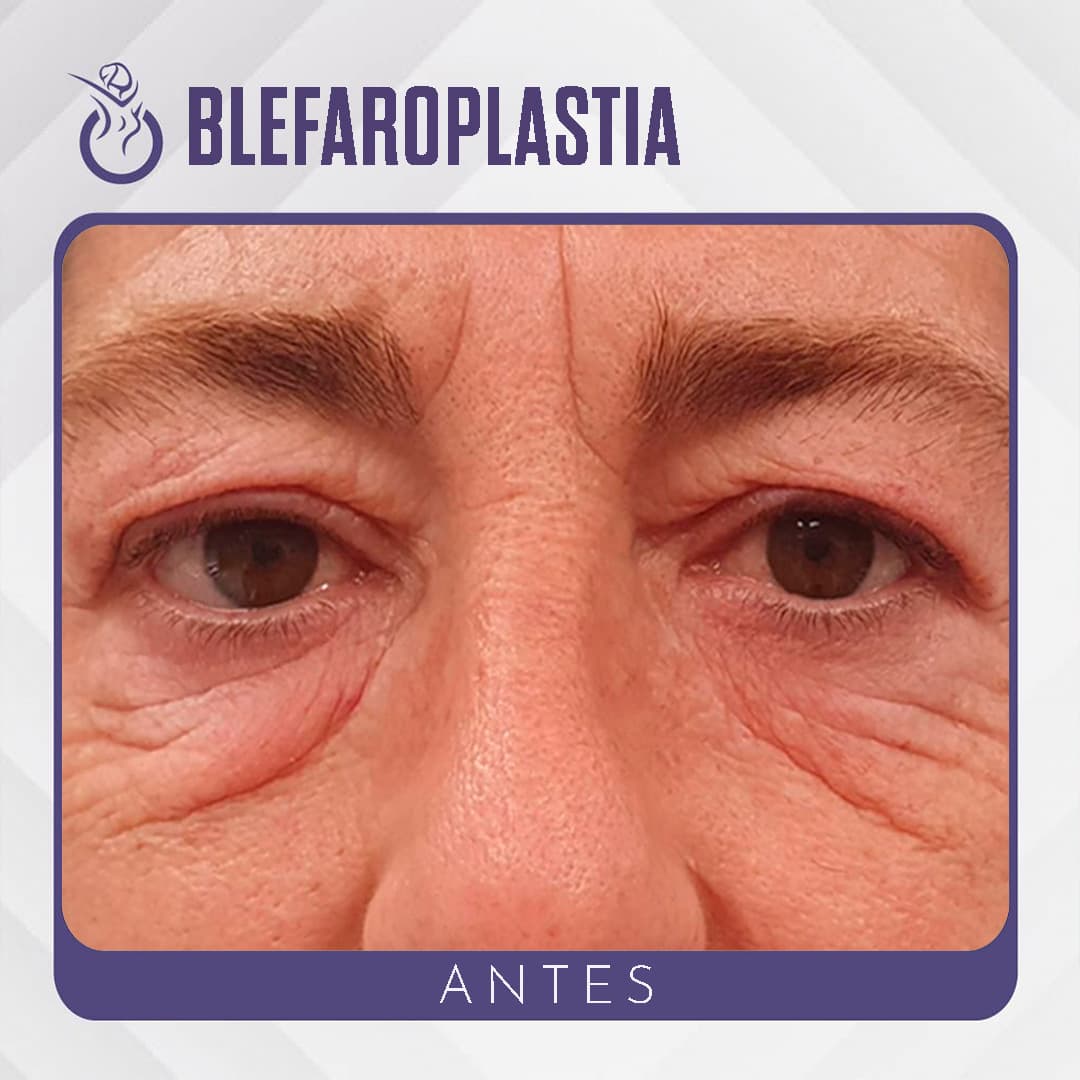 Blefaroplastia - Antes