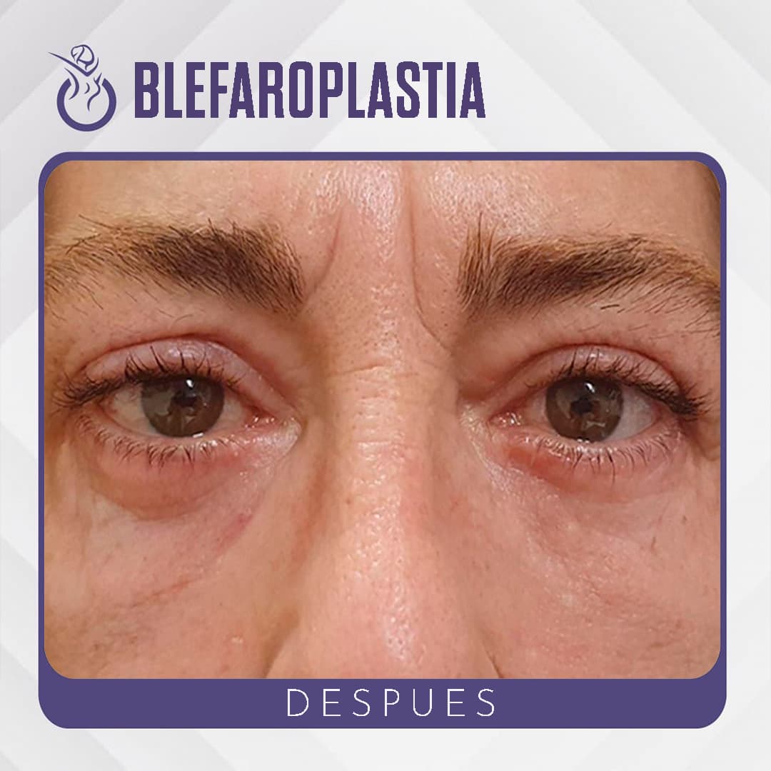 Blefaroplastia - Después