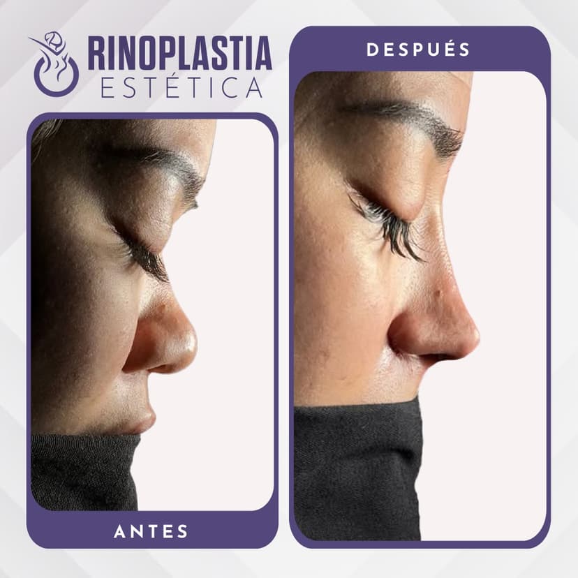 Rinoplastia con Tecnología Avanzada: Un Enfoque Innovador para una Nariz Perfecta