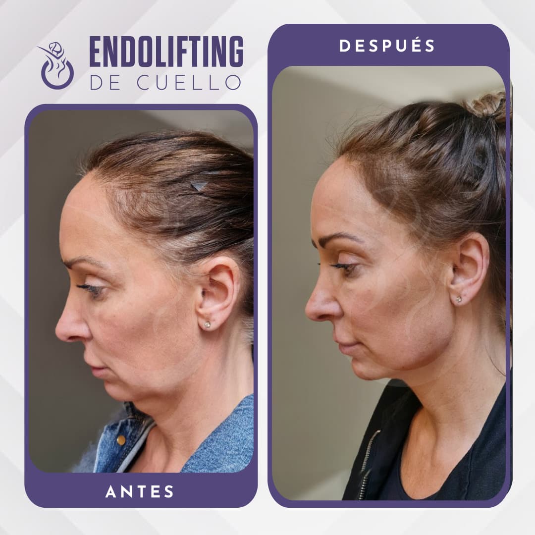 Endolifting - Antes